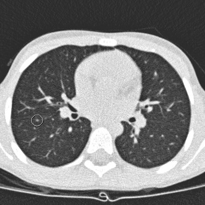 Verdachte vlekjes in de longen gedragen zich niet als uitzaaiingen van rhabdomyosarcoom