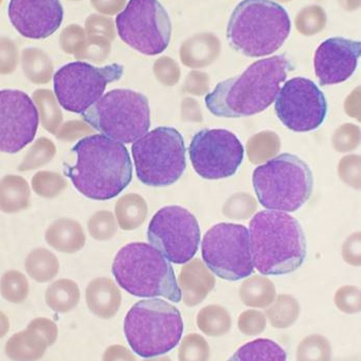 Aggressive form of childhood leukemia mapped for research into new treatment