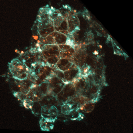 Illuminating neuroblastoma tumors with fluorescence