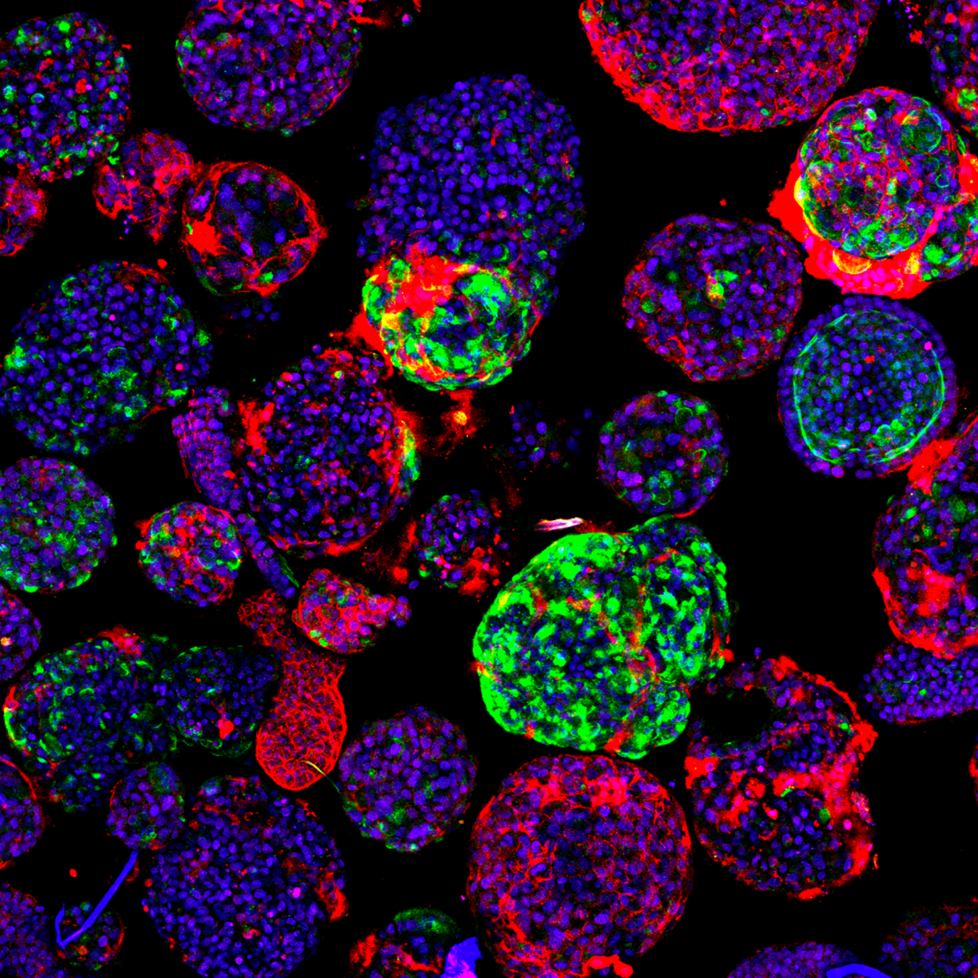 New insights into liver cancer using mini organs