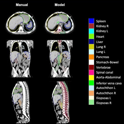 AI-radiotherapietool maakt sneller en consistenter aftekenen van organen mogelijk