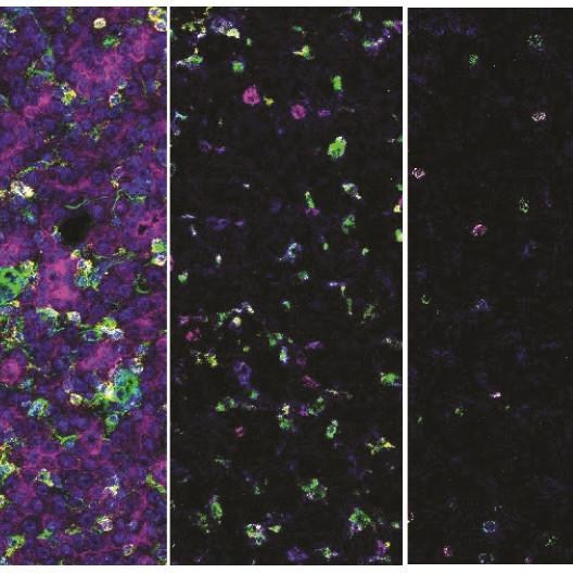 Myeloid cells offer new lead for immunotherapy in liver cancer