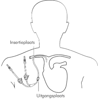 snelweg Belofte bruiloft Centraal veneuze katheter/lijn - Prinses Máxima Centrum - Zorg